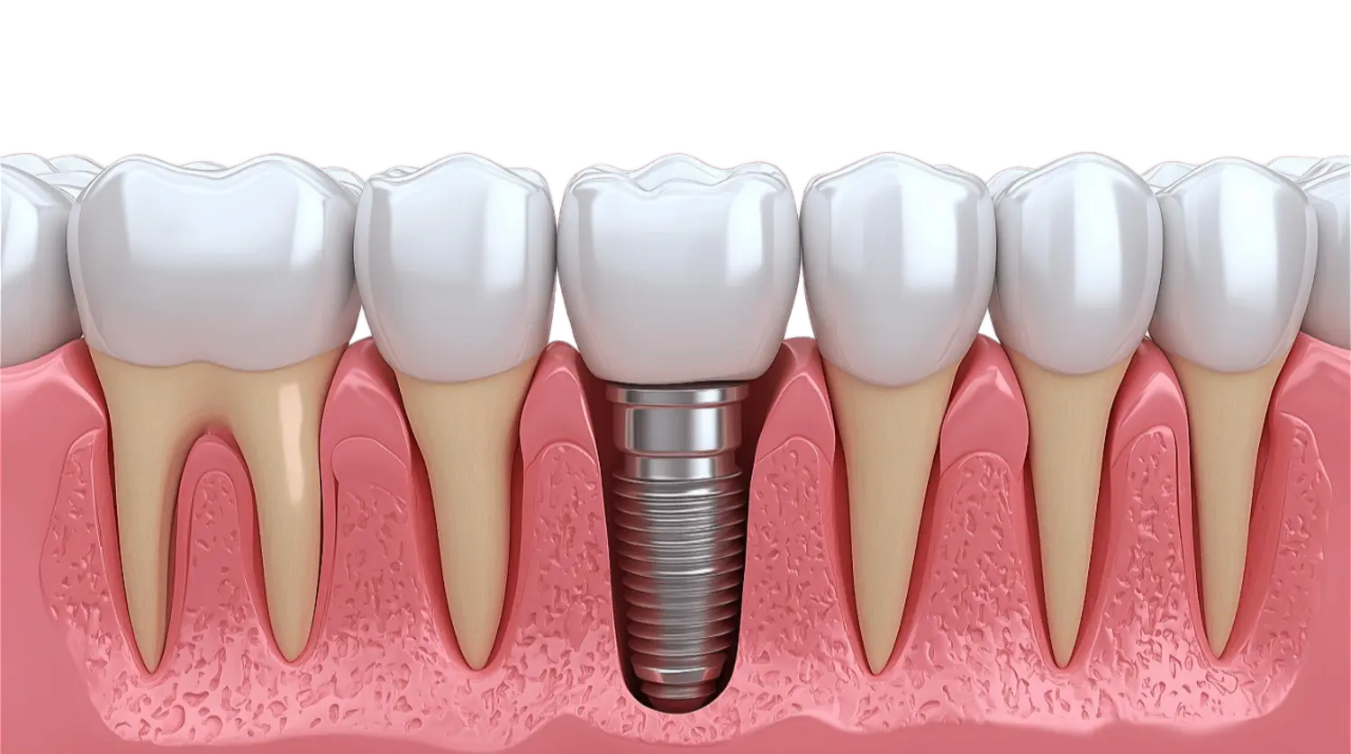 Баннер Дентальная имплантация зубов в Москве